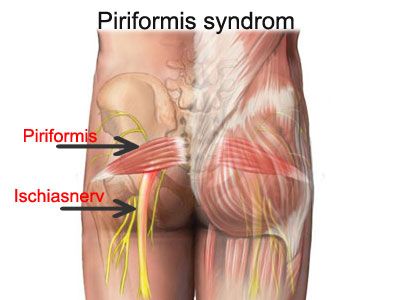 Piriformis syndrom