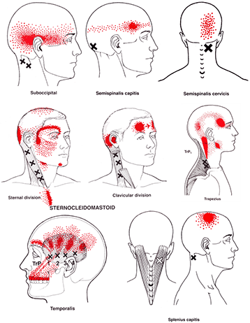 Huvudvärk från Triggerpunker