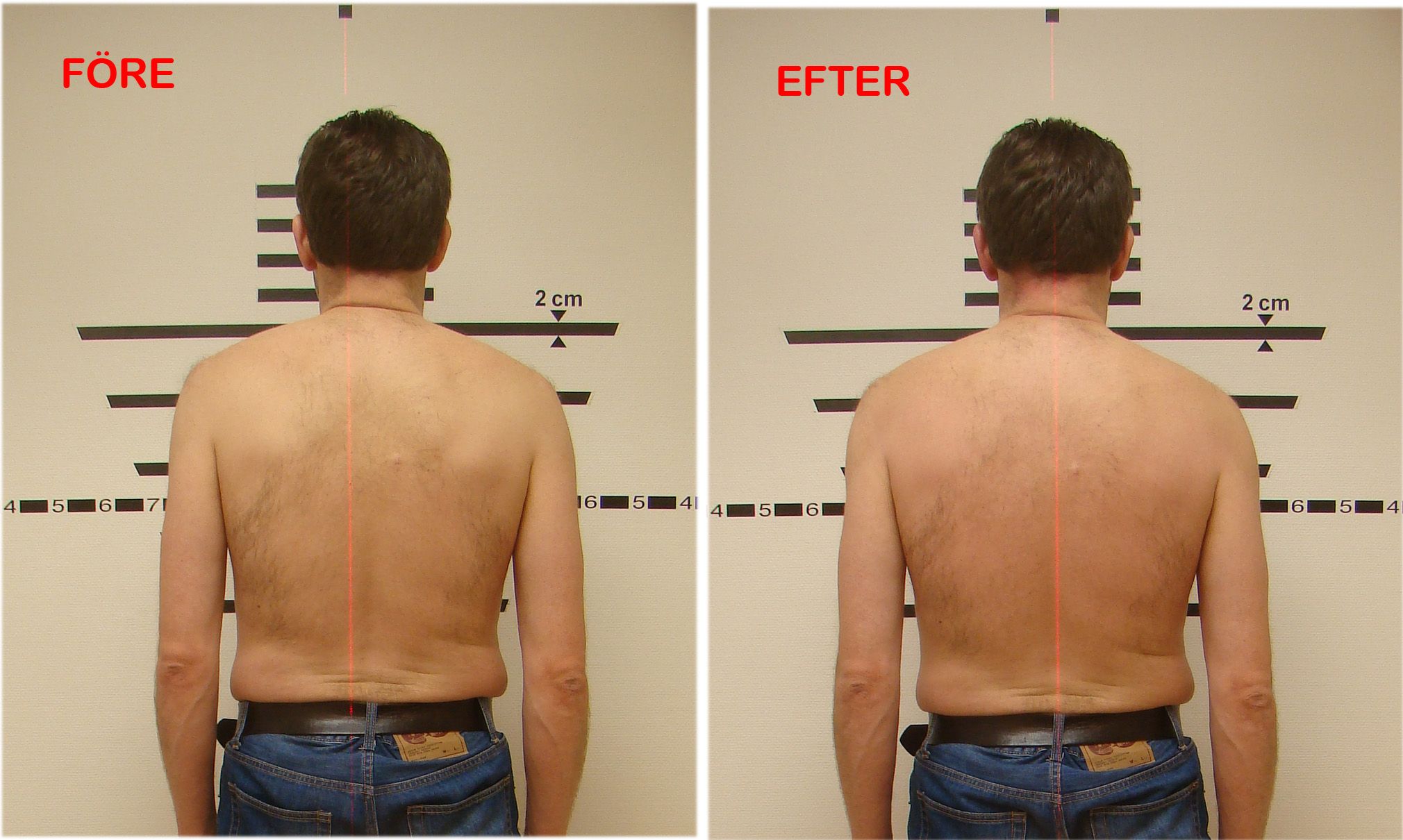 Mikael ryggbilder före och efter behandlingen